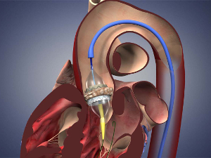 Замена аортального клапана
