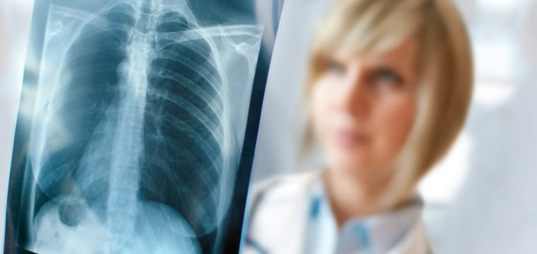 Mesothelioma Cancer Attorney