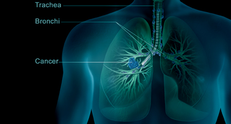 mesothelioma cancer