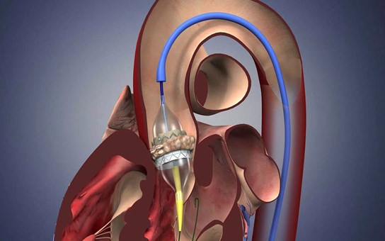Восстановление и замена аортального клапана